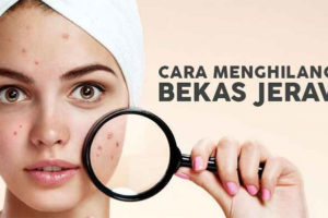 CARA Gampang Menghilangkan Noda Hitam Bekas Jerawat